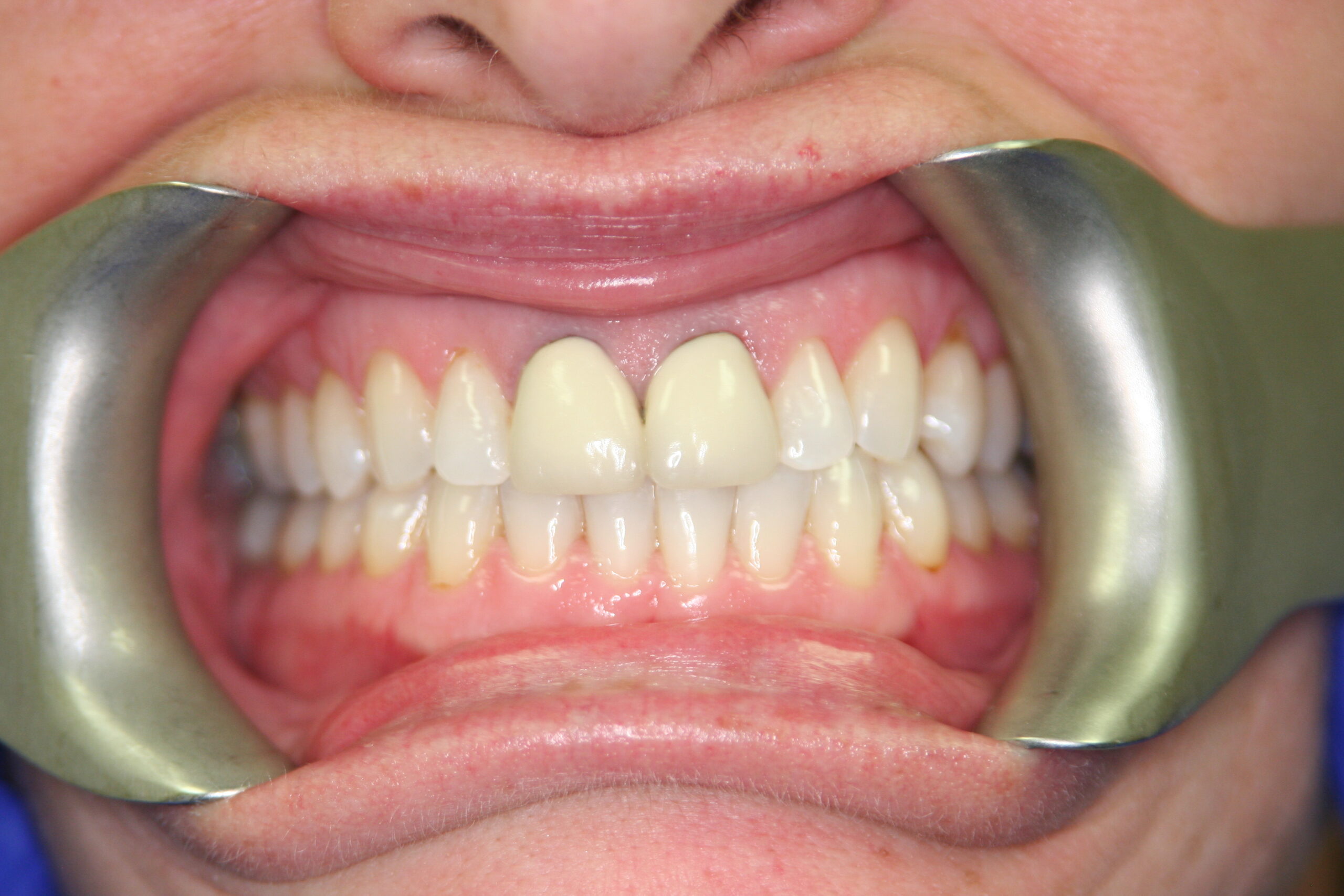 teeth whitening before