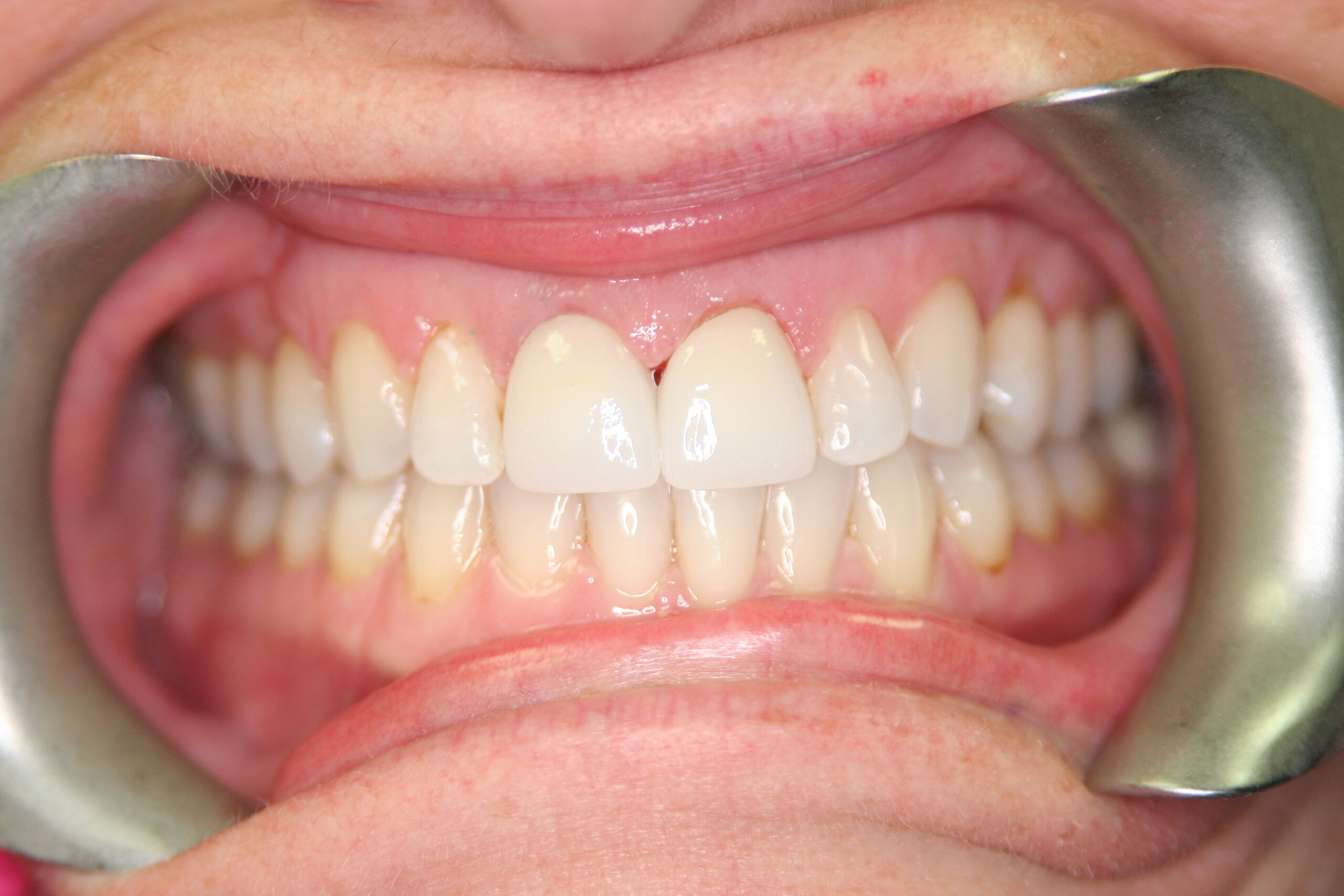 teeth whitening after