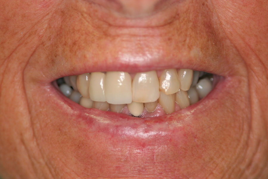 teeth whitening before