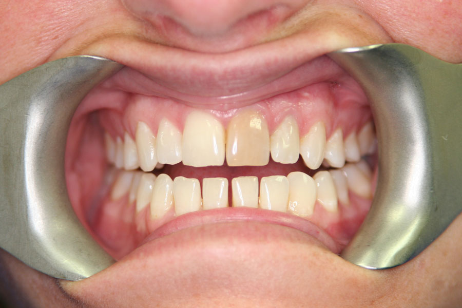 teeth whitening before
