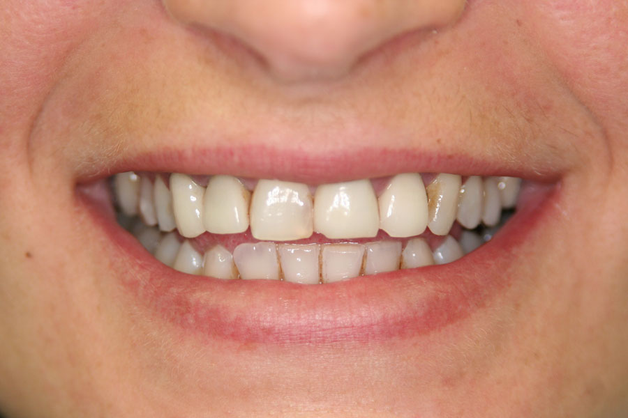 teeth whitening before