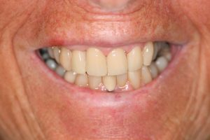 teeth whitening after