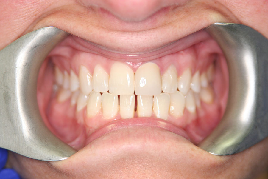 teeth whitening after