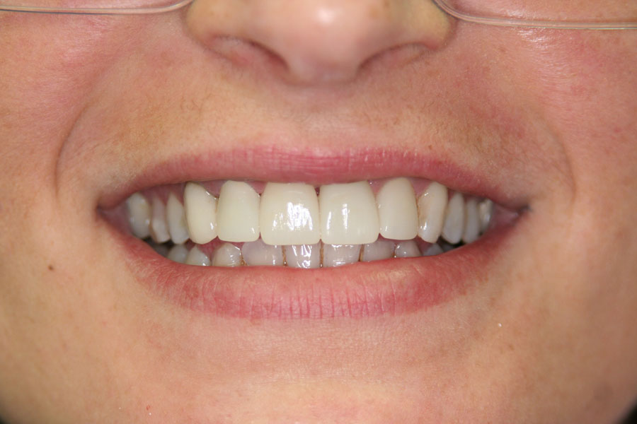 teeth whitening after