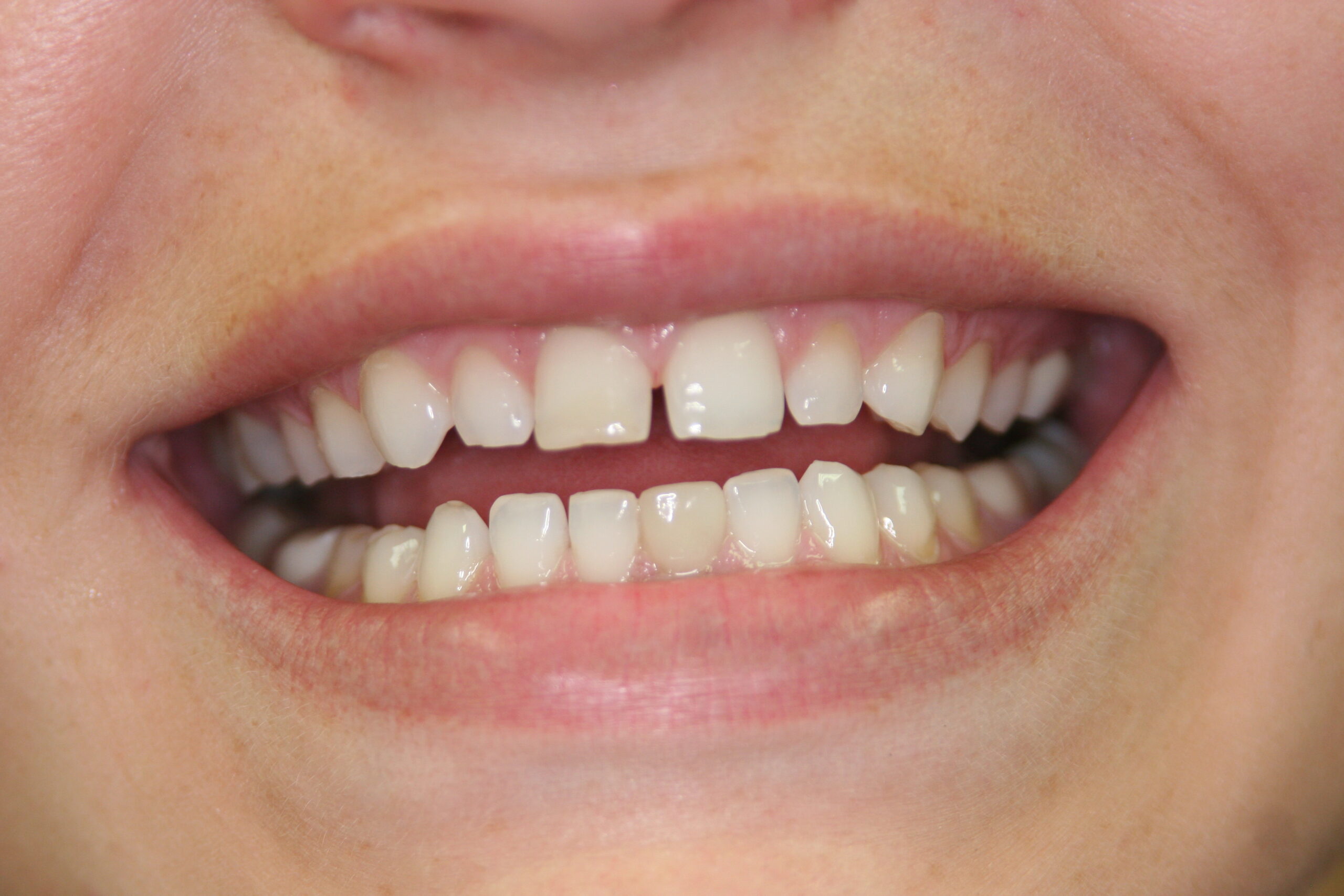 teeth straightening before