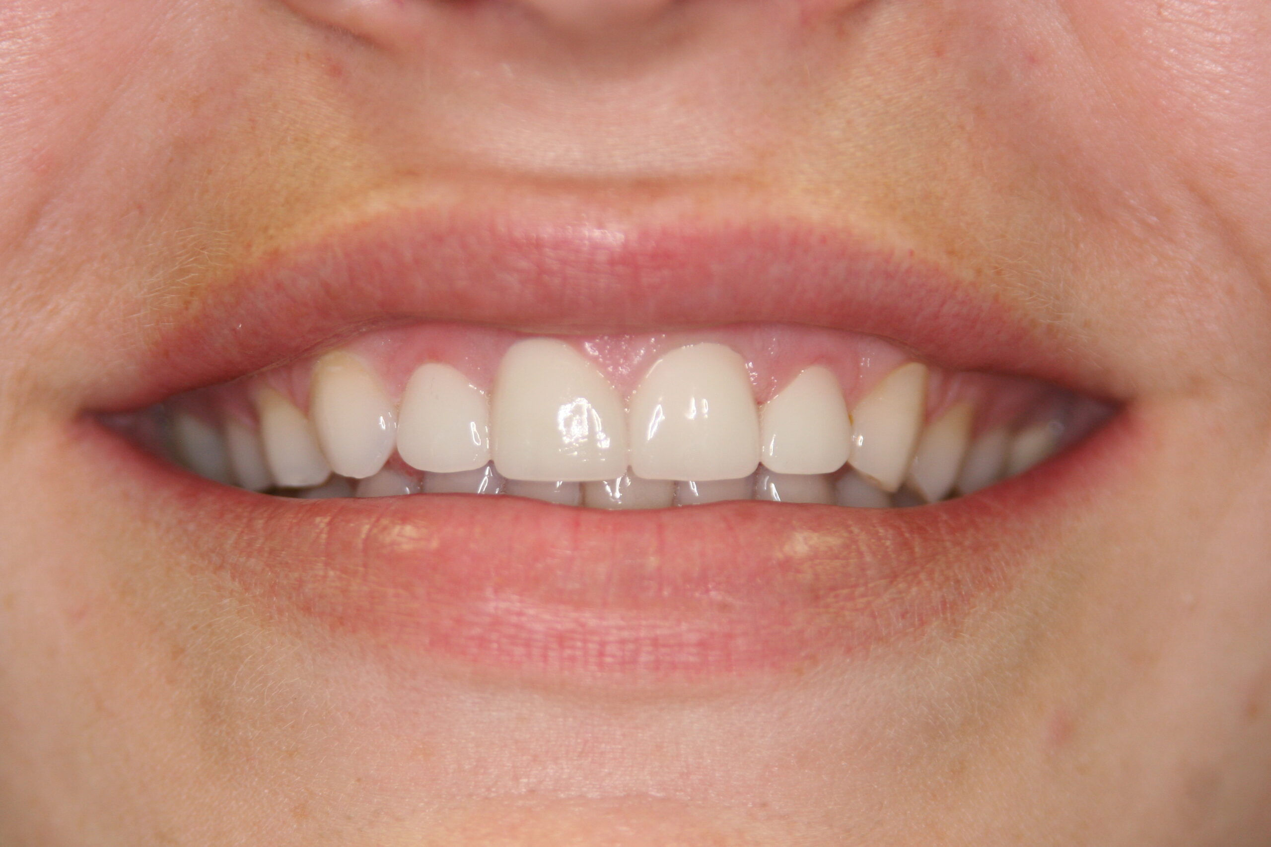 teeth straightening after