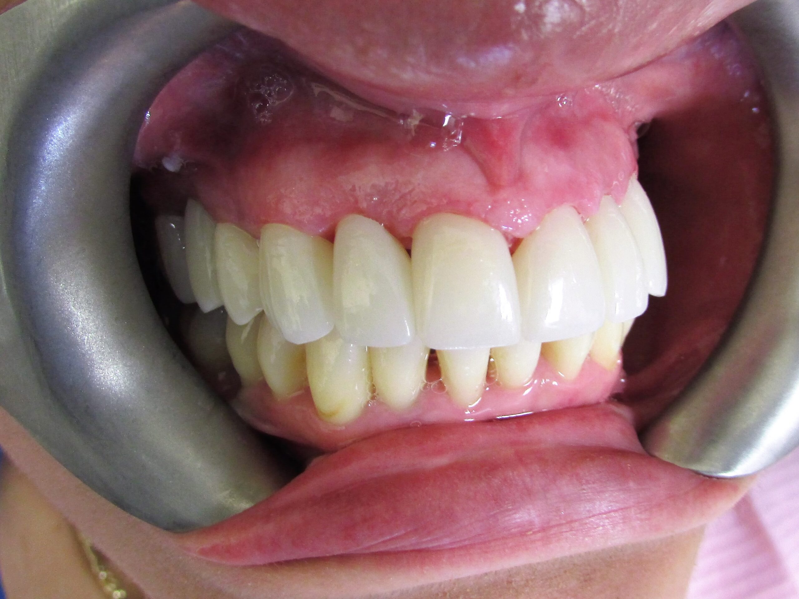 teeth straightening after